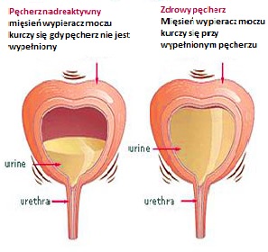 PÄcherz nadreaktywny 